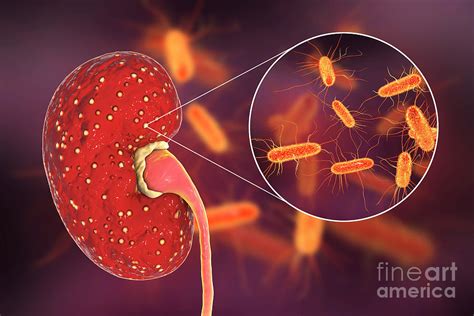 Acute Pyelonephritis Caused By E Coli Photograph By Kateryna Kon