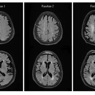 Representative T2 Flair Images Illustrating Fazekas Score Download Scientific Diagram