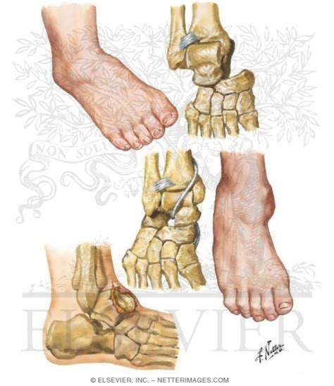 dislocation  subtalar joint  talus
