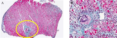 Histopathological Findings After Rv Myocardial Biopsy A Infiltration