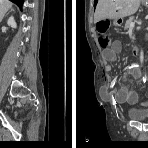 Image Of Twisted And Incarcerated Small Bowel Loops Herniating Through