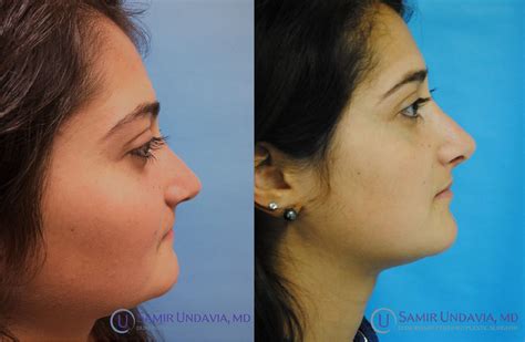 Revision Rhinoplasty Columelloplasty Rhinoplasty Nose Surgery Nose