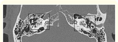 High Resolution Computed Tomography Hrct Temporal Bone Reveals