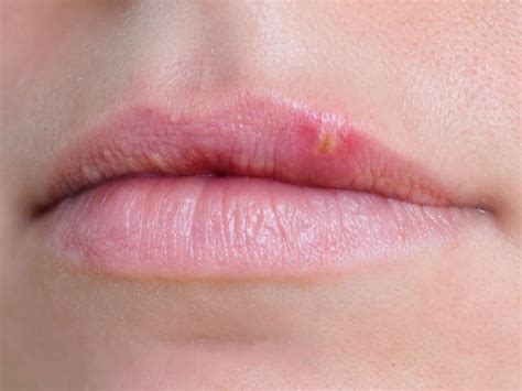 What can cause a bump on the lip? | Blister on lip, How to line lips ...