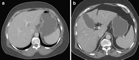 A Cect Abdomen Ct Axial Image At The Level Of Stomach Showing Adequate Download Scientific