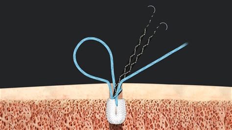 Arthrex Onlay MPFL Reconstruction Using Hybrid Knee FiberTak Anchors