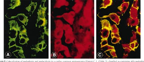 Figure 8 From Angiosarcomas Express Mixed Endothelial Phenotypes Of