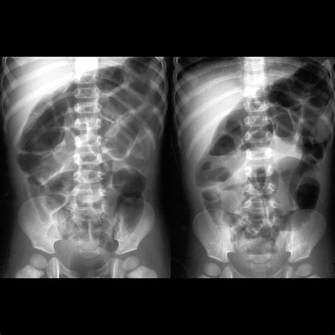 Pediatric Ileus Pediatric Radiology Reference Article Pediatric