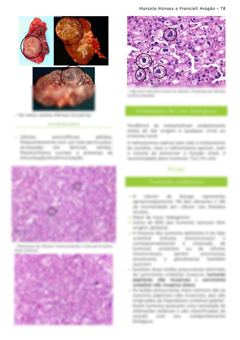 Solution Neoplasias Renais E Urol Gica Studypool