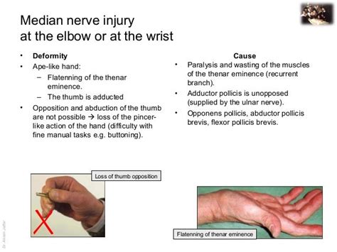 Applied Anatomy Median Nerve Injury