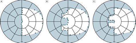 Peripheral Prism Glasses For Hemianopia Neuro Ophthalmology Jama Ophthalmology The Jama