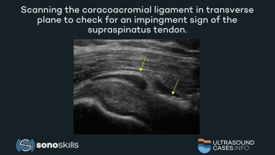 Coracohumeral Ligament Ultrasound