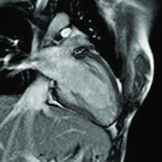 Cardiac Magnetic Resonance Imaging In Coronal Plane Shows Cardiac