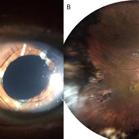 A Slit Lamp Postoperative Photograph Showing The Anterior Chamber