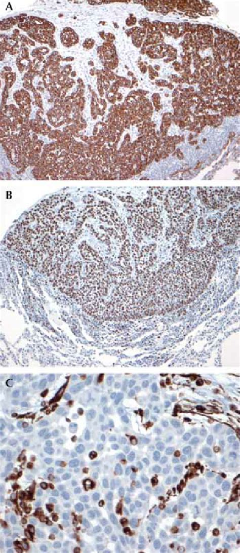 A Immunohistochemistry For Keratin Ae Ae Shows Strong Positive