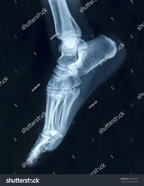 Film X Ray Normal Humans Foot Lateral Stock Photo 203109709 Shutterstock