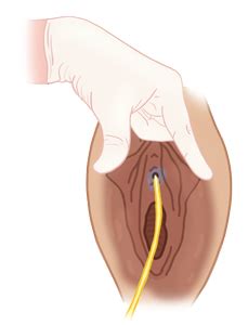 How To MASTER The Foley Catheter Insertion Advanced Tips Tricks