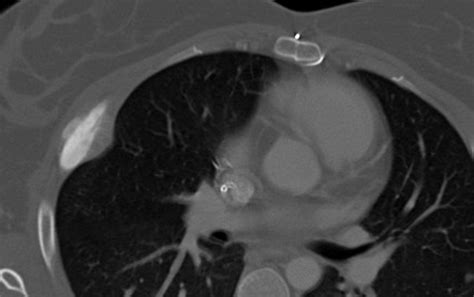 Ct Of Rib Lesions Ajr