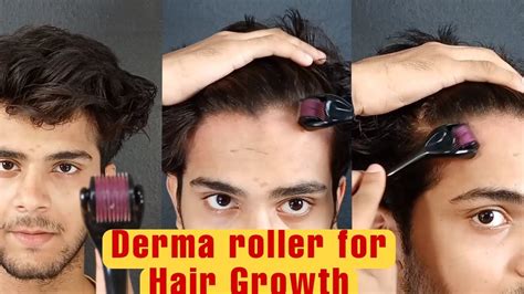 Derma Roller For Hair Growth Youtube