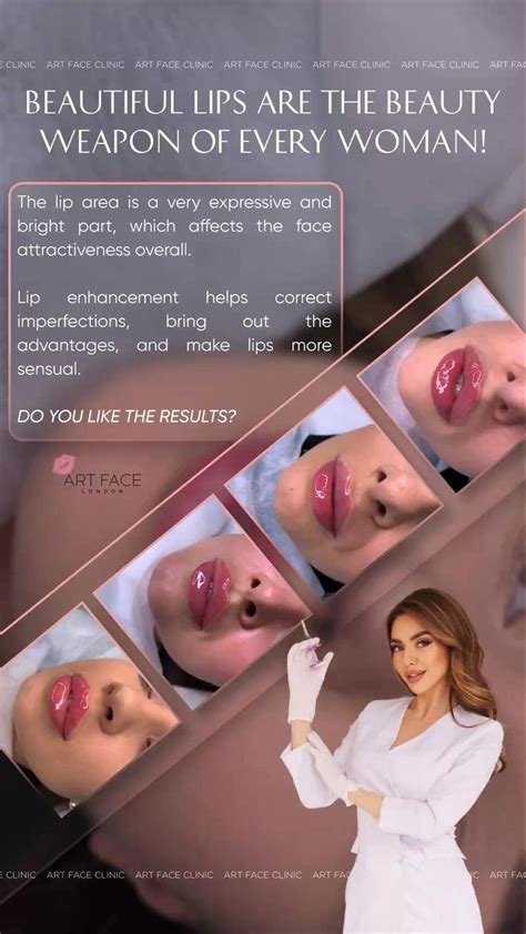 Art Face Clinic Russian Lips Lips Augmentation Lips In London Before