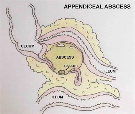 The Radiology Assistant Appendicitis US Findings