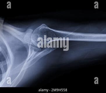 X Ray Shoulder Joint Shoulder Transaxillary View For Diagnosis Fracture