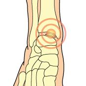 Talar Dome Lesion ← Tendonitis of Foot