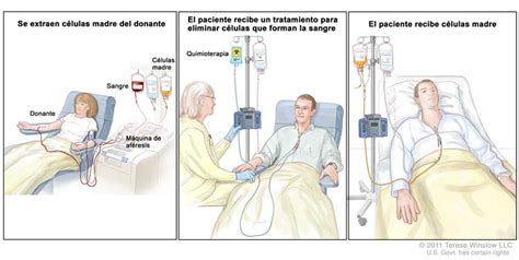 Trasplante De C Lulas Madre Panel Ilustraci N De La Extracci N De