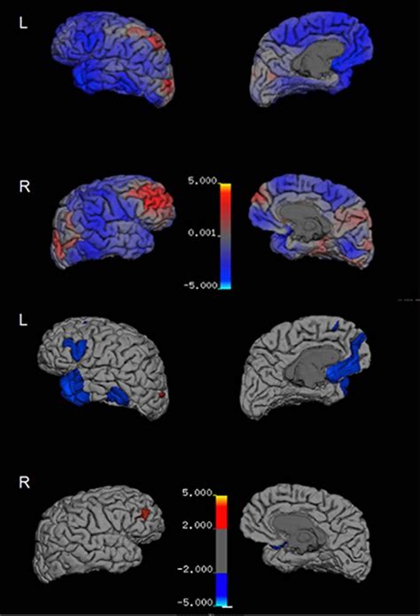 Experimental Imaging Agent Reveals Concussion Related CTE in Living Brain - Neuroscience News