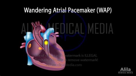 Alila Medical Media EKG ECG