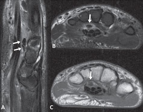 Scielo Brasil Imaging Findings Of Acute Calcific Periarthritis