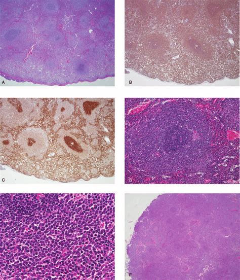 Pathological Analysis Of The Spleen A C Infiltration Of Lymphoma Download Scientific Diagram