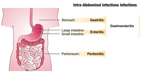 Intraabdominal Infections