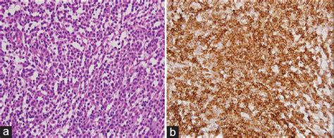 Solitary Extramedullary Plasmacytoma Of Thoracic Epidural Space Presenting With Dorsal