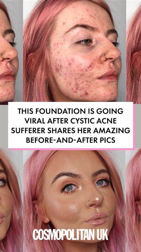 This foundation is going viral after cystic acne sufferer shares her 'insane' before-and-after ...