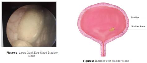 Bladder Stone Removal Cystolitholapaxy