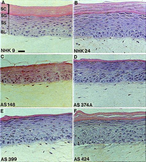 Xeroderma Pigmentosum Histology