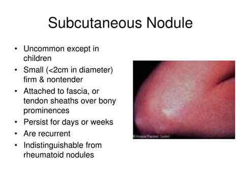 Ppt Overview Of Acute Rheumatic Fever Symptoms Diagnosis And Management Powerpoint