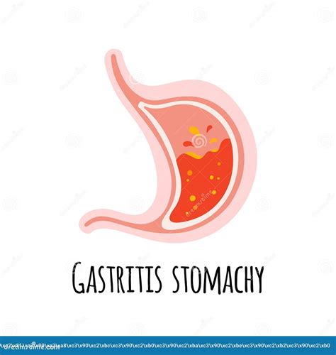 The Stomach Of A Person With Gastritis Gastroenterology Vector