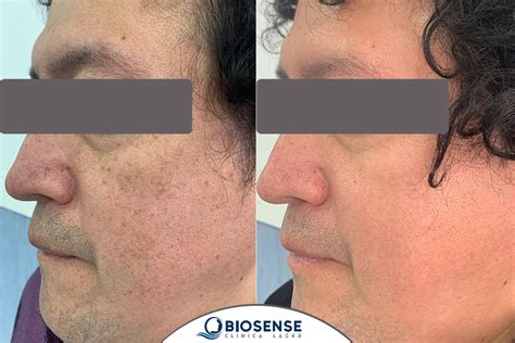 Tratamiento De Las Manchas En La Piel CLINICA LASER BIOSENSE