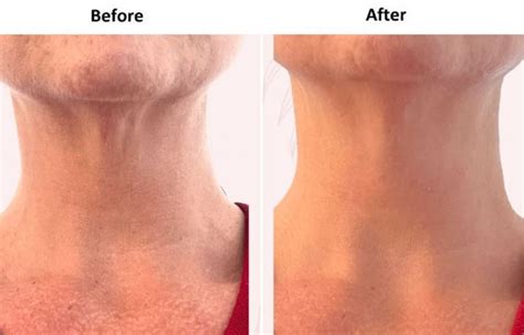 Face Neck Lift Aesthetics Face And BodySculpting