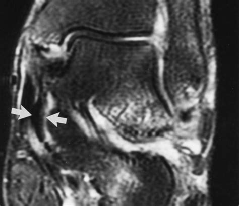 Sinus Tarsi Radiology