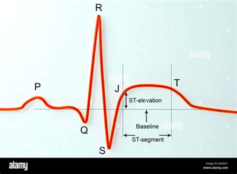 Electrocardiograma Ecg Durante Un Infarto De Miocardio Ataque