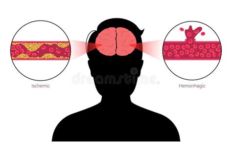 Brain Stroke Ishemic And Hemorrhagic Stock Vector Illustration Of Cardiovascular Pressure