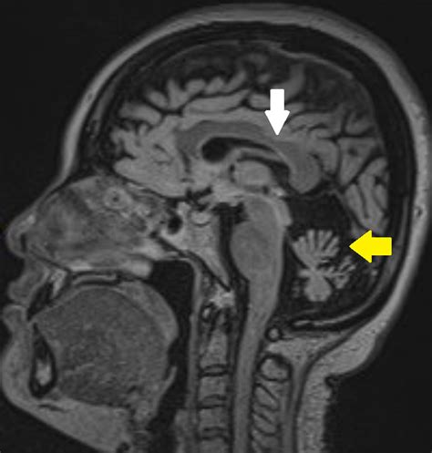 Friedreich Ataxia Mri