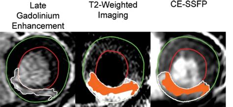 Graphical Display Of Myocardial Salvage Mid Ventricular Short Axis