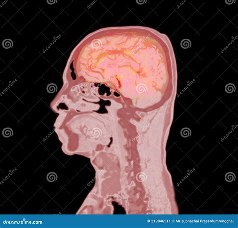 Colorful Of CT Angiography Of The Brain Or CTA Brain Sagittal View