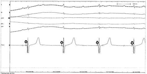 His Bundle Signal On Pacing Lead After Coiling Of Lead Download Scientific Diagram