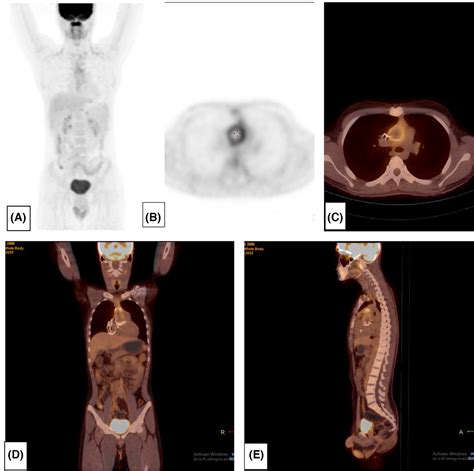 Evaluation Of Vascular Graft Infection Following Bentall Surgery Using