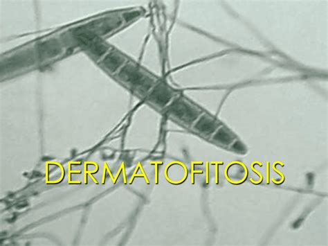 Dermatofitosis Documento Docsity